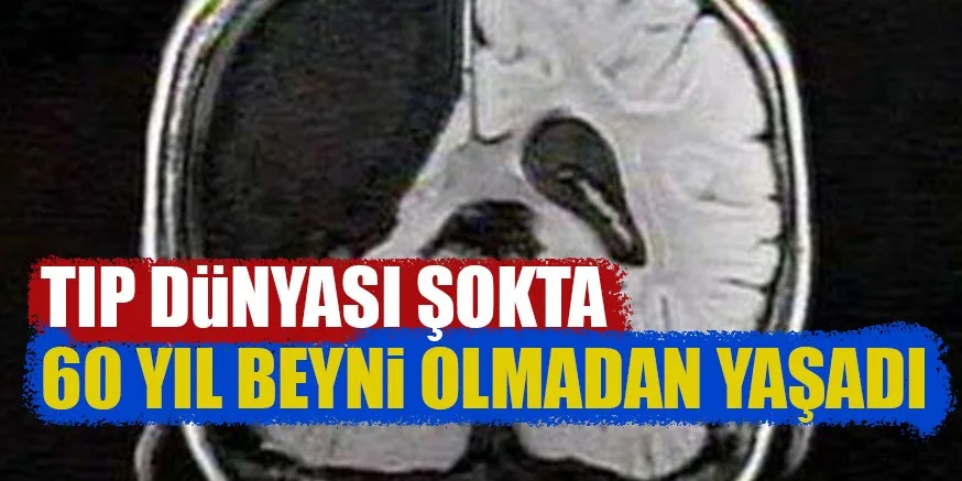 TIP DÜNYASI ŞOKTA 60 YIL BEYNİ OLMADAN YAŞADI