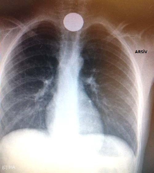 Madeni para yutan çocuk hastanelik oldu