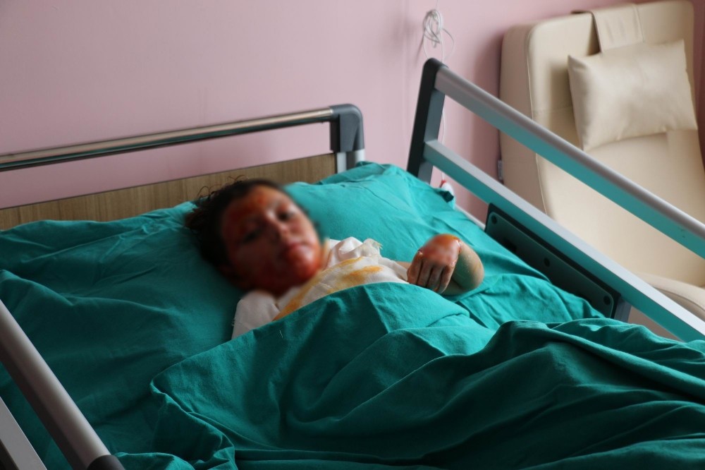 Halepte Soba Yakarken Yanan Kardeşler Sivasta Tedavi Görüyor