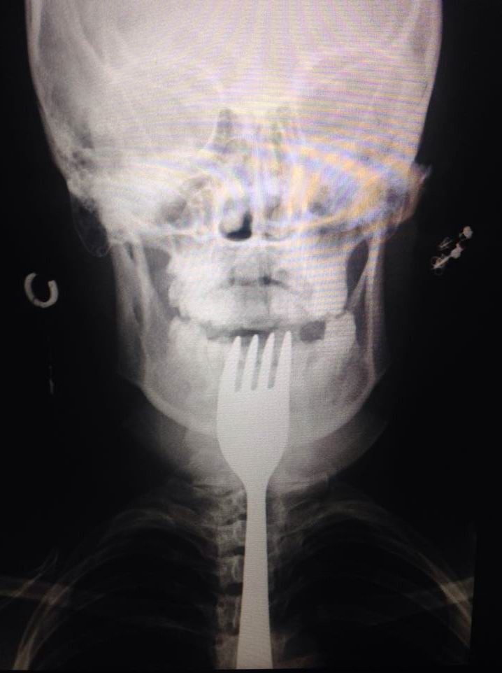 Dişini Karıştırdığı Çatal Boğazına Kaçtı