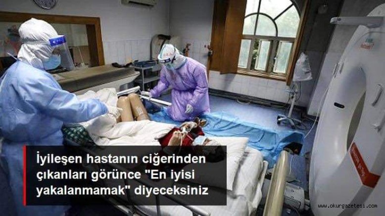 İyileşen korona hastasının akciğerinde sıvı veya parçacık dolu keseler bulundu