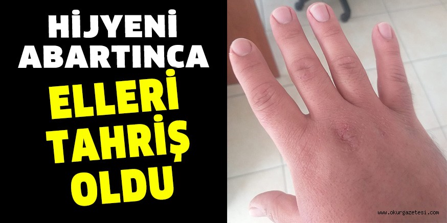 HİJYENİ ABARTINCA ELLERİ TAHRİŞ OLDU