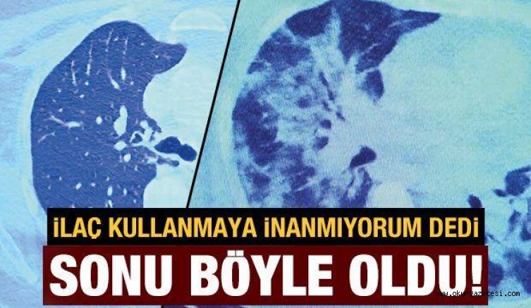 İlaç kullanmayan hastanın akciğeri sıvıyla doldu