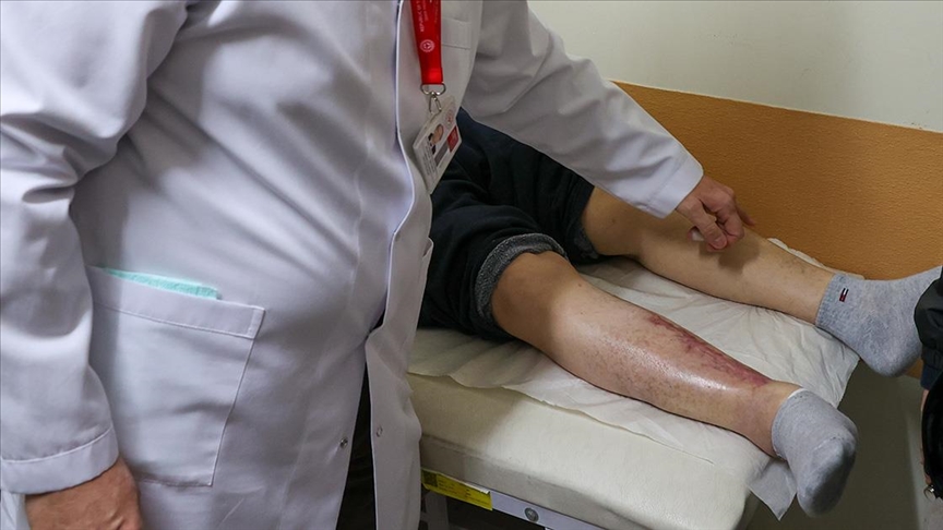 Kapanmayan yaralarından kök hücre tedavisiyle kurtuldu