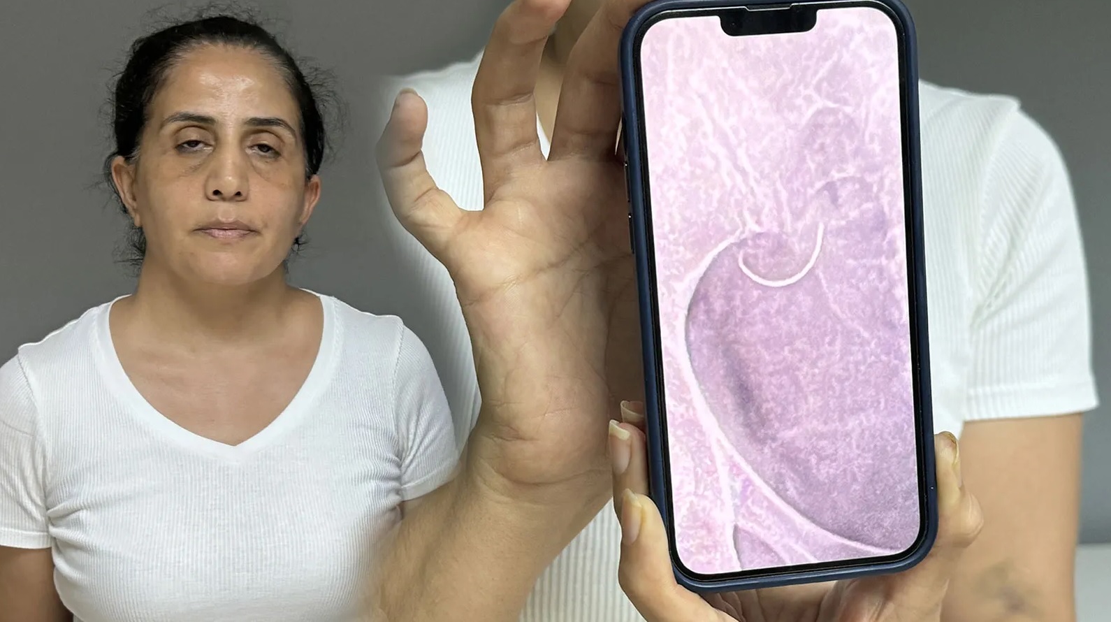 1,5 yıldır karnında unutulan iğne ile yaşıyor